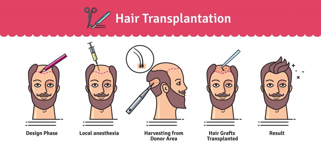 Hair Transplant Graft Chart
