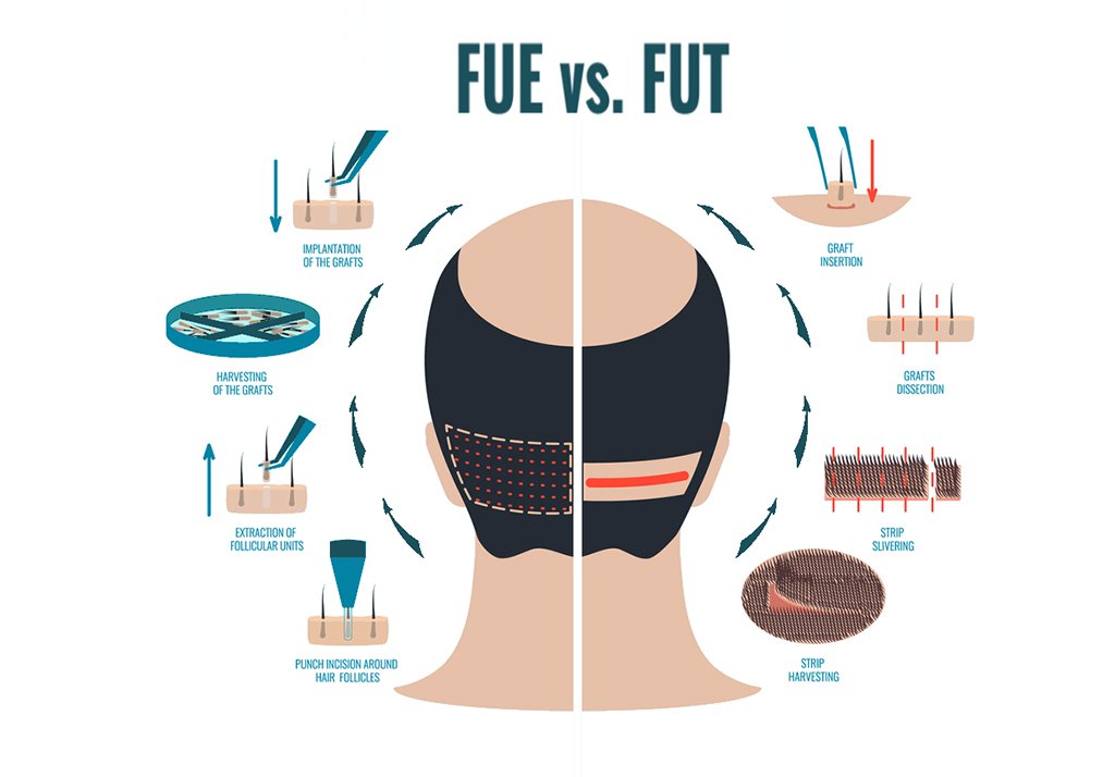 FUE vs FUT Hair Transplant | Skin and Sculpt | Chandigarh | Panchkula | Mohali | India | North India