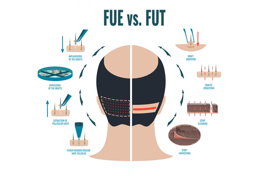 FUE vs FUT Hair Transplant | Skin and Sculpt | Chandigarh | Panchkula | Mohali | India | North India